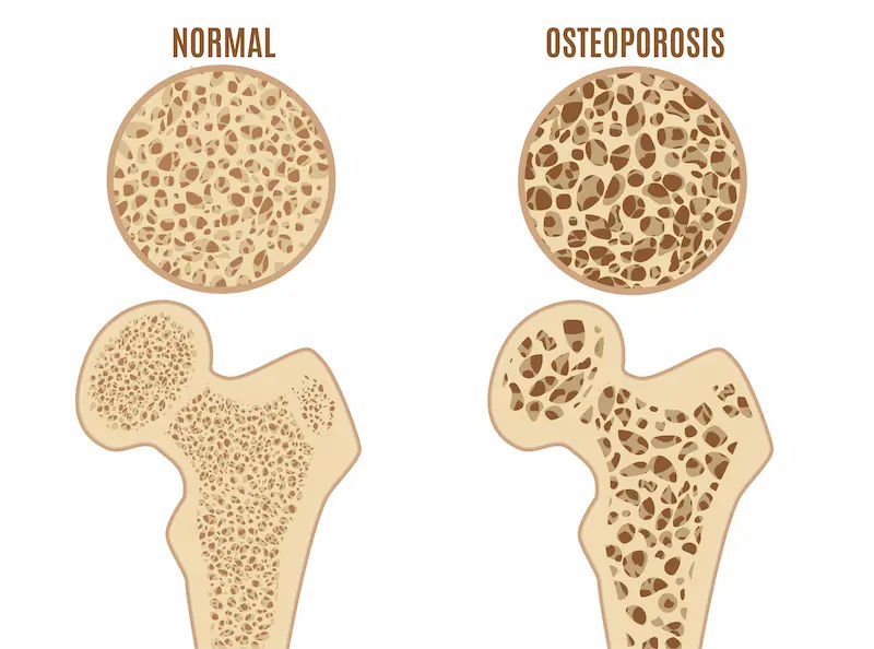 Understanding Osteoporosis Causes and Bone Impact